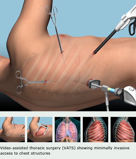 Lung Abscess Predicts The Surgical Outcome In Patients With Enlarge Malignant Mesothelioma