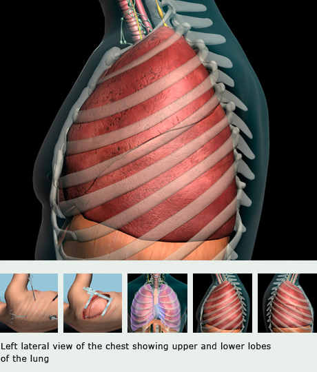 VATS Procedure Video Assisted Thoracic Surgery